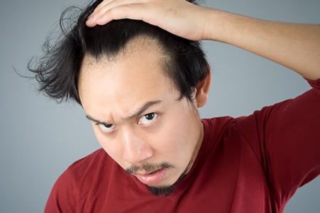 後退した生え際を発毛させる方法は 男性薄毛治療に関する疑問に答えるwebマガジン