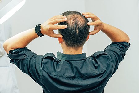 つむじハゲ 薄毛 の原因は 男性薄毛治療に関する疑問に答えるwebマガジン