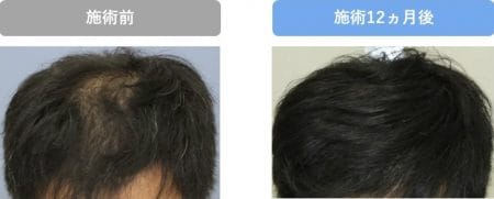 スマートFUE植毛【施術後12ヵ月】20代男性