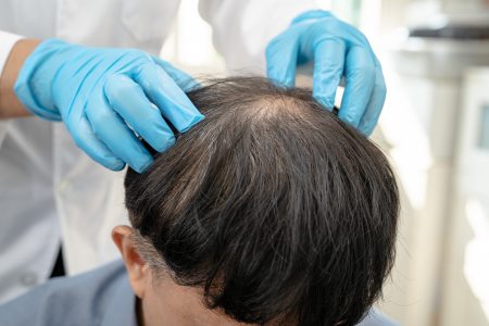 薄毛治療の様子