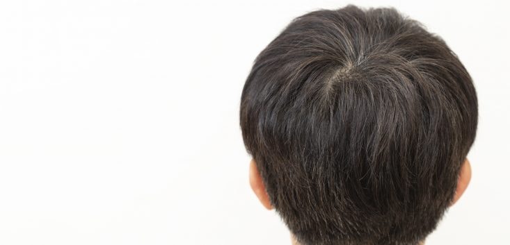 男性のつむじ