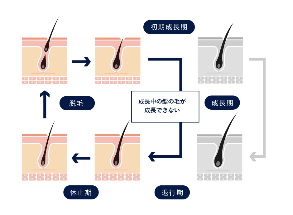 AGAのヘアサイクル