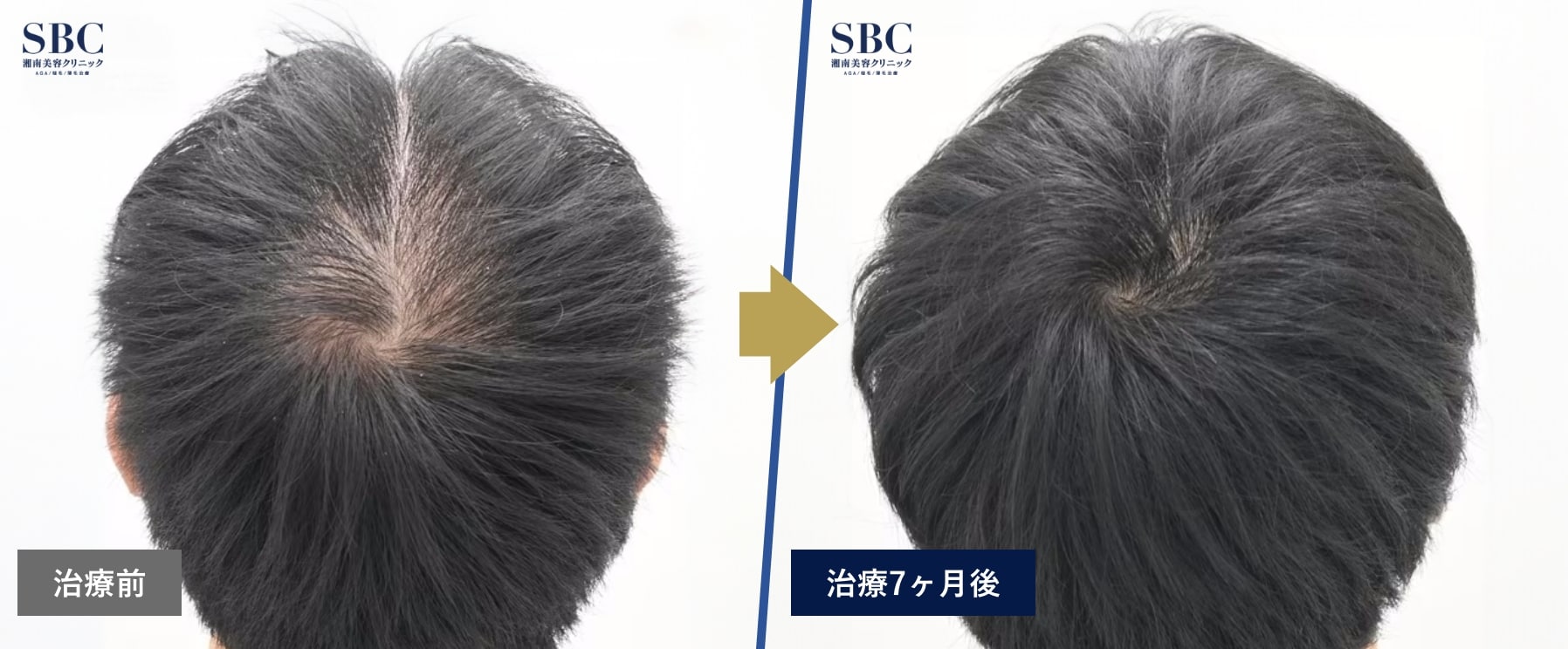 【症例写真】AGA治療薬＋ダブルマトリックスの治療前と治療｛7ヵ月後｝