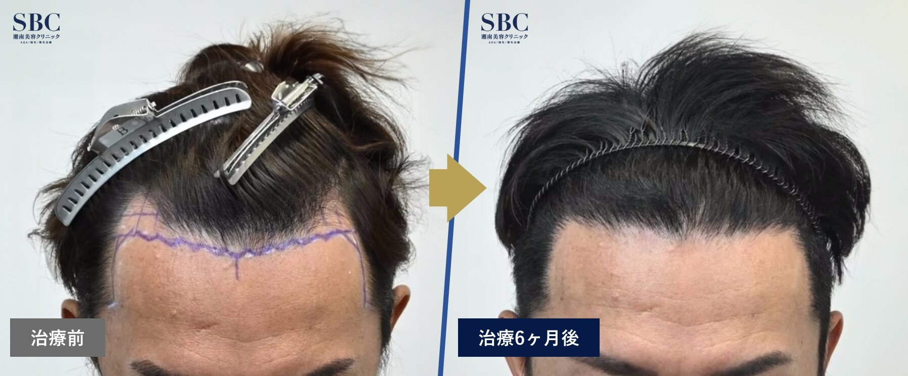 【症例写真】AGA治療薬+スマートメソセラピーの治療前と治療｛6ヵ月後｝