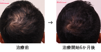 AGA治療薬で治療したAGA薄毛治療の症例写真 Before Aftere（治療6ヵ月後）