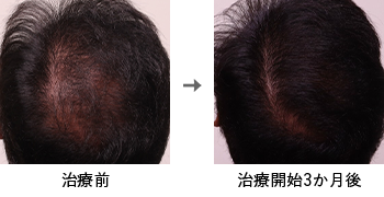 AGA治療薬で治療したAGA薄毛治療の症例写真 Before Aftere（治療3ヵ月後）
