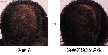 AGA治療薬で治療したAGA薄毛治療の症例写真 Before Aftere（治療3ヵ月後）
