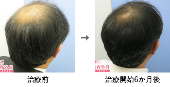 AGA治療薬で治療したAGA薄毛治療の症例写真 Before Aftere（治療6ヵ月後）