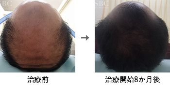 AGA治療薬で治療したAGA薄毛治療の症例写真 Before Aftere（治療8ヵ月後）