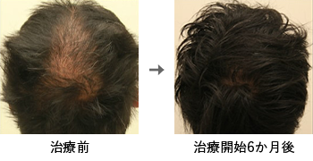 AGA治療薬で治療したAGA薄毛治療の症例写真 Before Aftere（治療6ヵ月後）