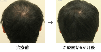 AGA治療薬で治療したAGA薄毛治療の症例写真 Before Aftere（治療6ヵ月後）