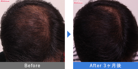 AGA治療薬で治療したAGA薄毛治療の症例写真 Before Aftere（治療3ヵ月後）