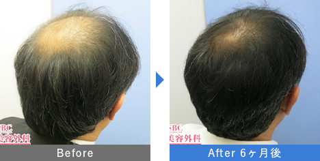 AGA治療薬で治療したAGA薄毛治療の症例写真 Before Aftere（治療6ヵ月後）