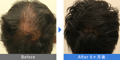 AGA治療薬で治療したAGA薄毛治療の症例写真 Before Aftere（治療6ヵ月後）