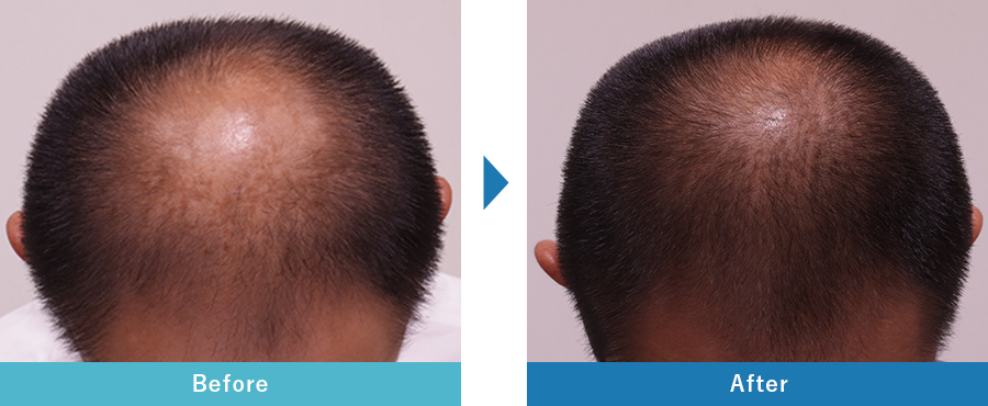 塗るフィナス症例写真 3ヶ月後 before