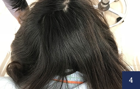 髪を下ろしてしまえば、採取部が見えません。