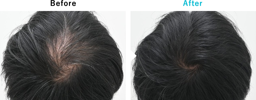 発毛レーザーFolixのピックアップ症例