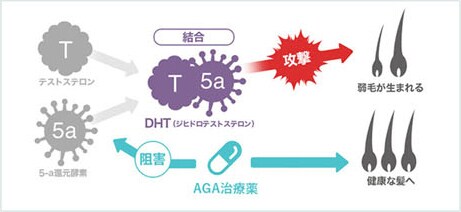AGA（薄毛）治療薬のイメージ