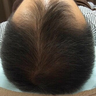 症例写真3-2