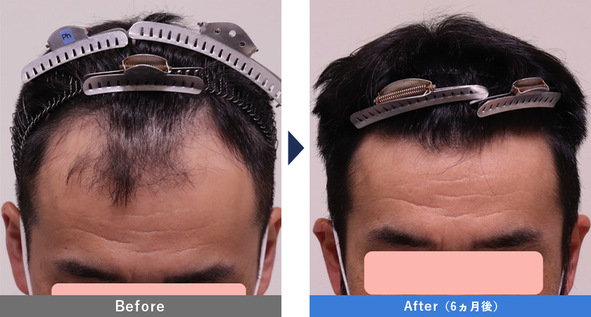40代男性1500GのスマートFUE植毛の症例写真