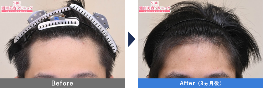 20代男性1000GのスマートFUE植毛の症例写真