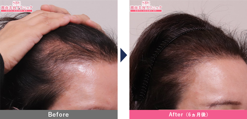 女性のスマートFUE植毛の症例写真