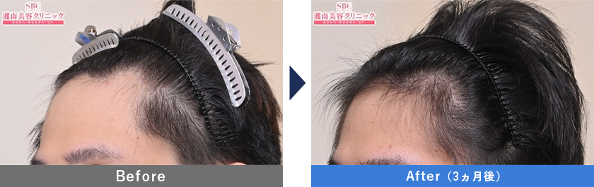 スマートFUE植毛の症例写真1000G