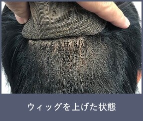 シークレットシェーブン植毛 湘南美容クリニック植毛薄毛治療