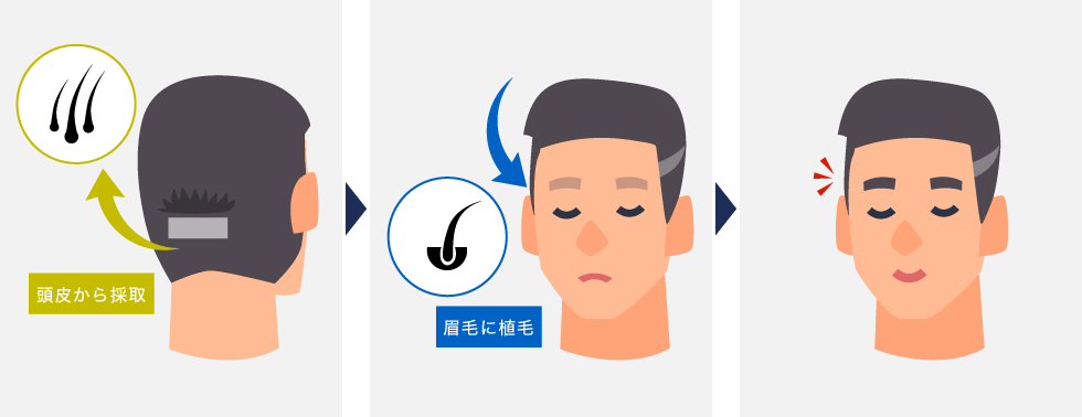 頭皮から元気な毛を採取してきて、眉毛にそのまま植毛する