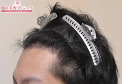 After（6ヵ月後）