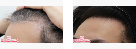 生え際の自毛植毛の症例写真ビフォーアフター1