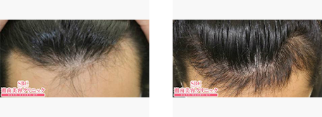 生え際の自毛植毛の症例写真ビフォーアフター2