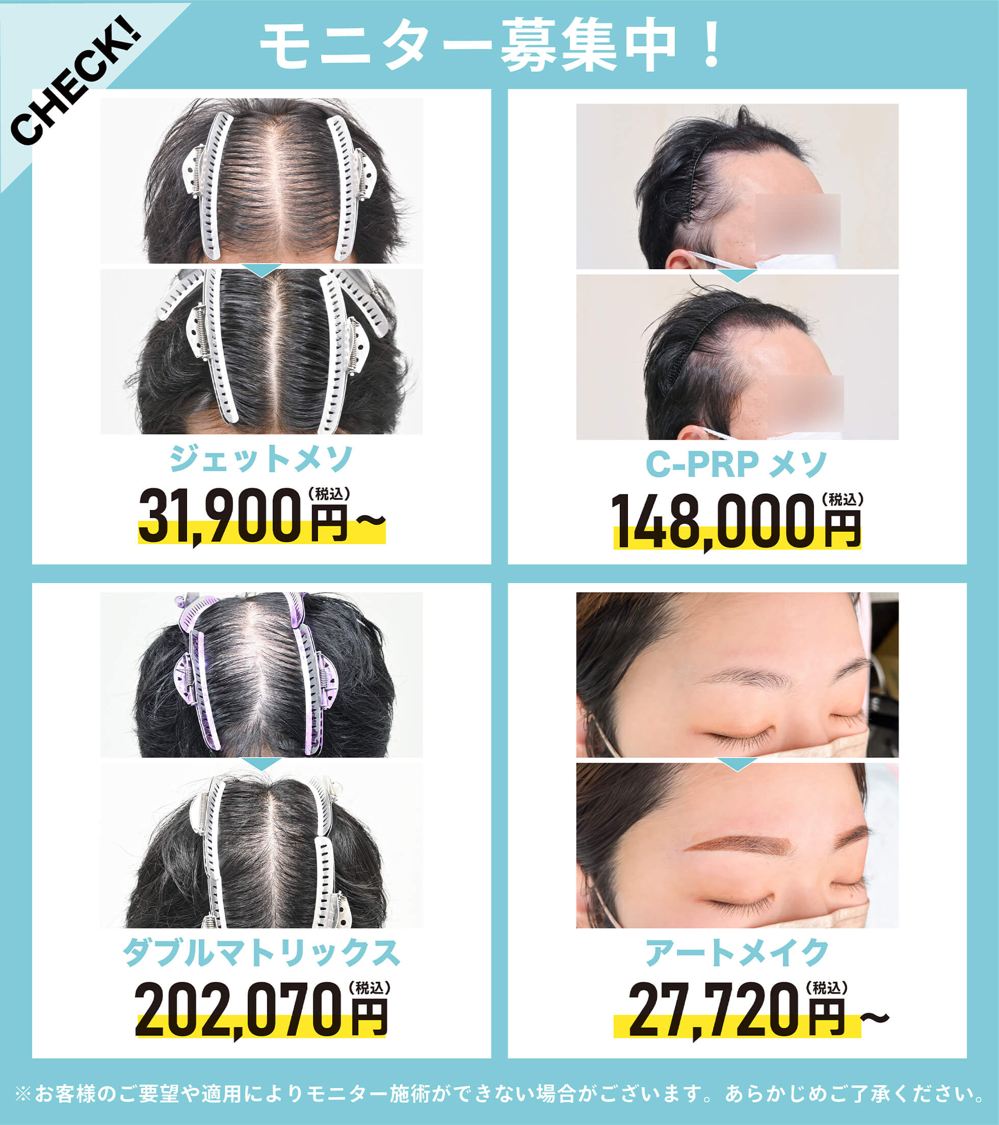 AGA名古屋院のモニター募集