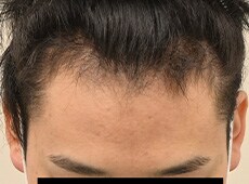 AGA横浜院による症例1