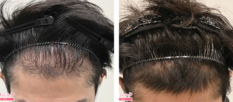 毛髪再生メソセラピーの症例写真ビフォーアフター1