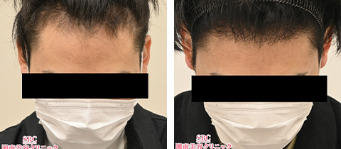自毛植毛1080グラフトの症例写真ビフォーアフター