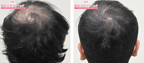 AGA治療薬＋毛髪再生メソセラピーの症例写真ビフォーアフター