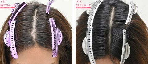 女性の薄毛治療の症例写真ビフォーアフター