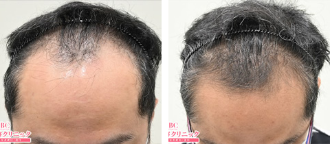 毛髪再生メソセラピー＋ダブルマトリックスの症例写真ビフォーアフター1