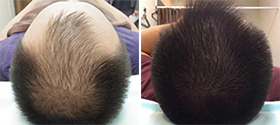 湘南AGAクリニック名古屋院での薄毛治療の症例写真ビフォーアフター