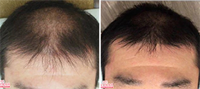 湘南AGAクリニック名古屋院での自毛植毛の症例写真ビフォーアフター