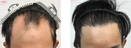 自毛植毛の症例写真ビフォーアフター1