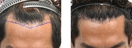 自毛植毛の症例写真ビフォーアフター3