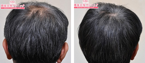 AGA治療薬の症例写真ビフォーアフター1