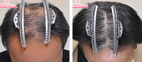 AGA治療薬の症例写真ビフォーアフター3