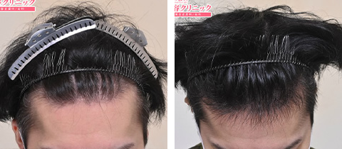 AGA治療薬とダブルマトリックスの症例写真ビフォーアフター
