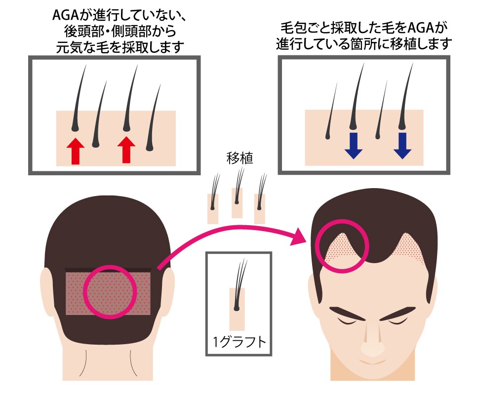 AGAが進行していない、後頭部・側頭部から元気な毛を採取します。毛包ごと採取した毛をAGAが進行している箇所に移植します。