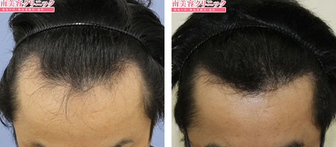自毛植毛の症例写真ビフォー 施術12ヶ月後2