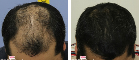毛髪再生メソセラピーの症例写真 施術ビフォー12ヶ月後1