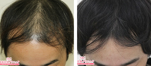 毛髪再生メソセラピーの症例写真 施術ビフォー12ヶ月後2